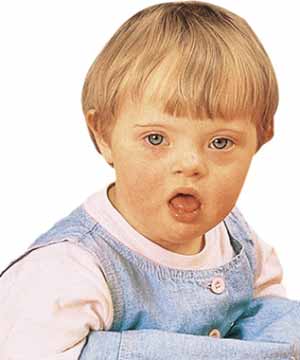 عقب ماندگی ذهنی در کودکان عقب ماندگی ذهنی در کودکان