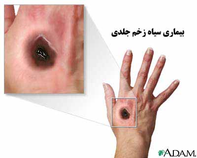 بیماری شاربن یا سیاه زخم ( Anthrax )