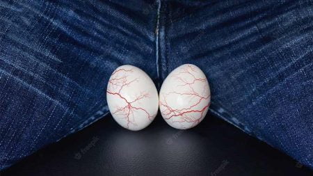 تعیین درجه واریکوسل تشخیص و درمان