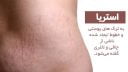 استریا - ترک های پوستی ناشی از چاقی و لاغری