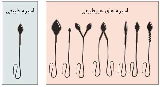 تفسیر آزمایش اسپرم - شکل طبیعی اسپرم