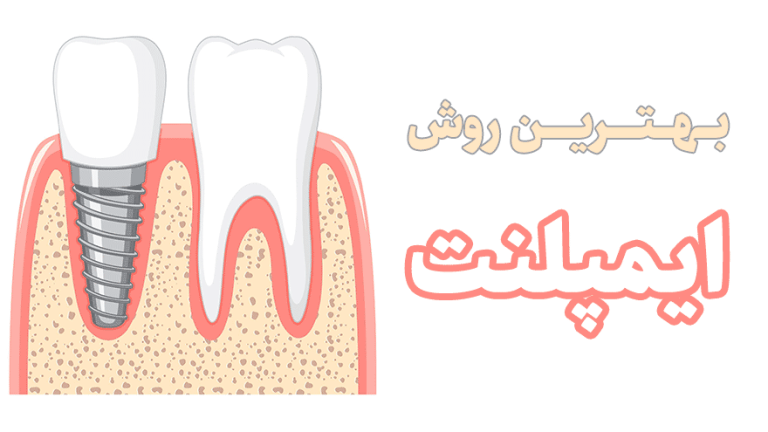 ایمپلنت دندان