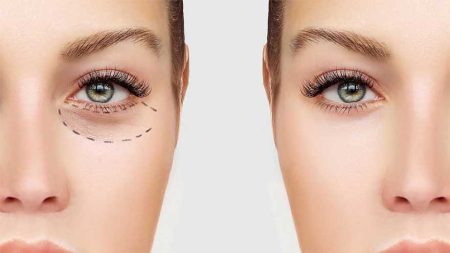 درمان افتادگی پلک چشم به روش‌های مختلف