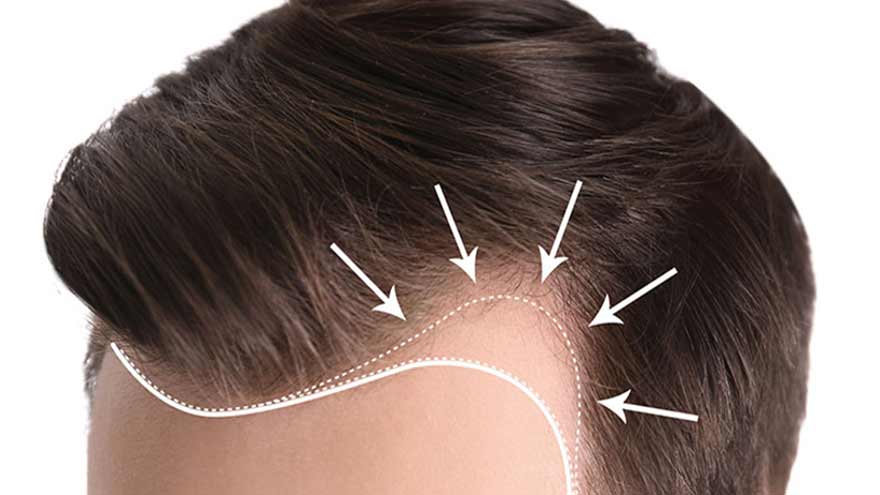 کاشت مو مزوتراپی رفع طاسی و مزایای کاشت مو و ابرو