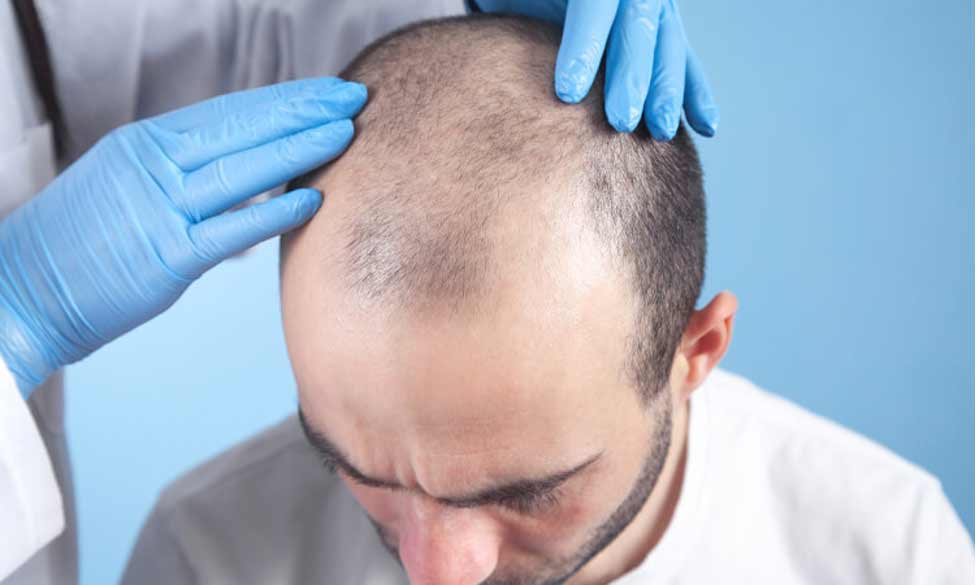 روش‌ها و عوارض کاشت مو و ابرو برای رفع کچلی و طاسی سر و جلوگیری از ریزش مو